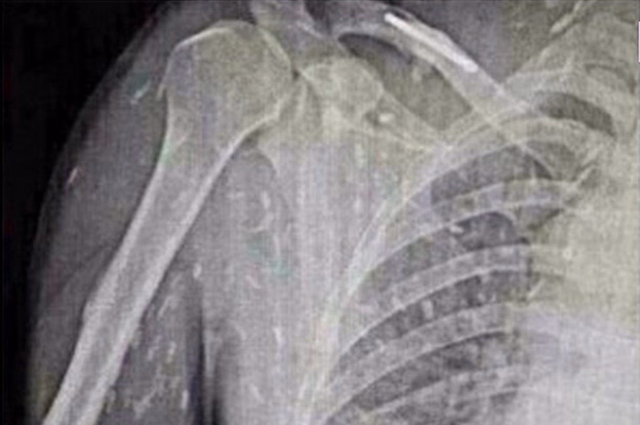 How do I know if I got worms from sushi?